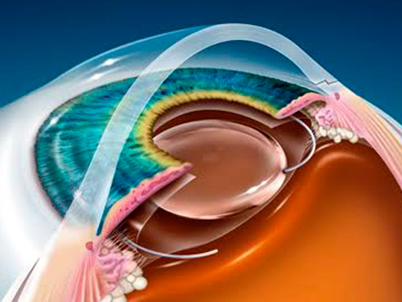 Cirurgia de Catarata