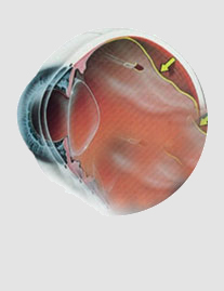 DESCOLAMENTO DE RETINA