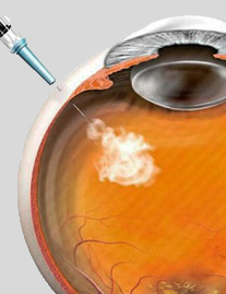 INJEÇÃO INTRAOCULAR