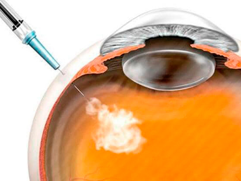 Injeção Intra-ocular