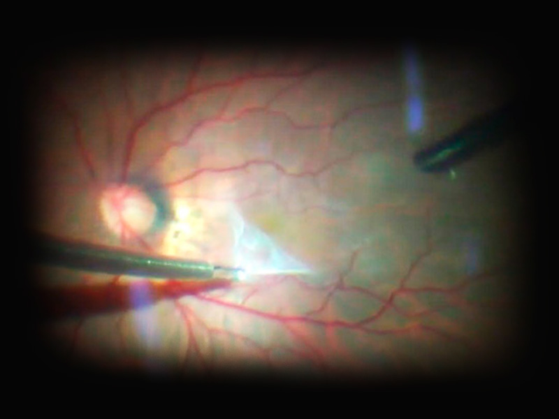 Membrana epirretiniana